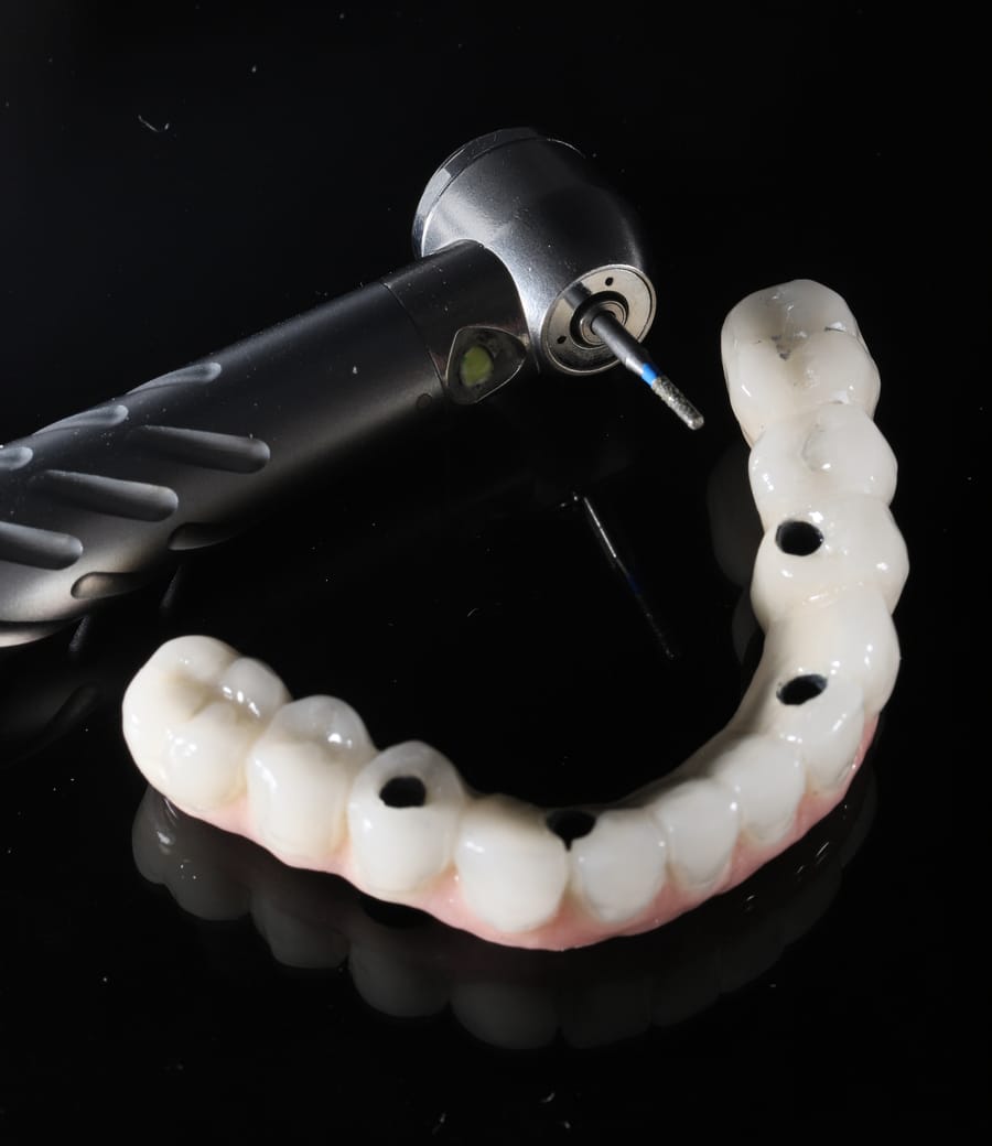 All-on-4 full arch dental implant prosthesis at Greenfield Dental, Hanoi Vietnam