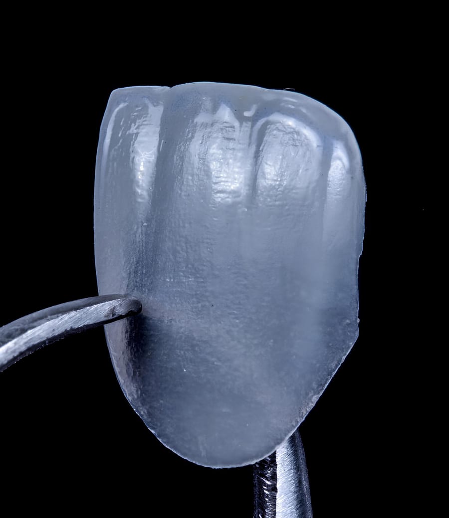 Porcelain veneer at Greenfield Dental, Hanoi Vietnam